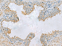 Immunohistochemistry of paraffin-embedded Human prost ate cancer tissue using PLA2G15 Polyclonal Antibody at dilution of 1:65 (×200)