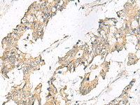 Immunohistochemistry of paraffin-embedded Human colorectal cancer tissue using MGAT4B Polyclonal Antibody at dilution of 1:50 (×200)