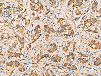 Immunohistochemistry of paraffin-embedded Human liver cancer tissue using VTA1 Polyclonal Antibody at dilution of 1:60 (×200)