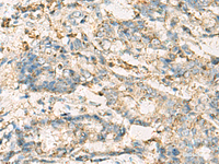 Immunohistochemistry of paraffin-embedded Human cervical cancer tissue using VTA1 Polyclonal Antibody at dilution of 1:60 (×200)