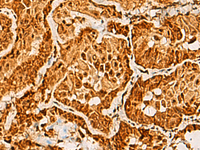 Immunohistochemistry of paraffin-embedded Human thyroid cancer tissue using SAP30BP Polyclonal Antibody at dilution of 1:40 (×200)