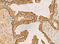 Immunohistochemistry of paraffin-embedded Human prost ate cancer tissue using AIMP1 Polyclonal Antibody at dilution of 1:55 (×200)