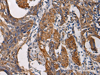 Immunohistochemistry of paraffin-embedded Human esophagus cancer tissue using SSH3 Polyclonal Antibody at dilution of 1:60 (×200)