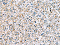 Immunohistochemistry of paraffin-embedded Human liver cancer tissue using MTHFD2 Polyclonal Antibody at dilution of 1:65 (×200)