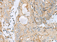 Immunohistochemistry of paraffin-embedded Human colorectal cancer tissue using MTHFD2 Polyclonal Antibody at dilution of 1:65 (×200)