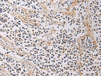 Immunohistochemistry of paraffin-embedded Human breast cancer tissue using GMPR Polyclonal Antibody at dilution of 1:60 (×200)