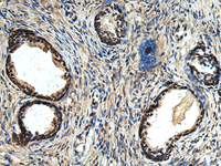 Immunohistochemistry of paraffin-embedded Human prost ate cancer tissue using ERLIN1 Polyclonal Antibody at dilution of 1:50 (×200)