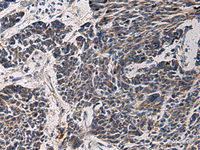 Immunohistochemistry of paraffin-embedded Human colorectal cancer tissue using CCNI Polyclonal Antibody at dilution of 1:65 (×200)