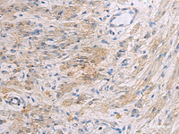 Immunohistochemistry of paraffin-embedded Human gastric cancer tissue using SLC30A3 Polyclonal Antibody at dilution of 1:55 (×200)