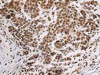 Immunohistochemistry of paraffin-embedded Human colorectal cancer tissue using CREBBP Polyclonal Antibody at dilution of 1:60 (×200)