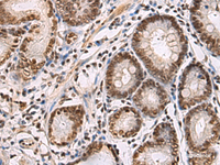 Immunohistochemistry of paraffin-embedded Human gastric cancer tissue using CREBBP Polyclonal Antibody at dilution of 1:60 (×200)