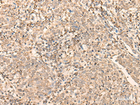 Immunohistochemistry of paraffin-embedded Human cervical cancer tissue using CCNE1 Polyclonal Antibody at dilution of 1:25 (×200)