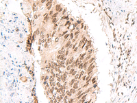 Immunohistochemistry of paraffin-embedded Human colorectal cancer tissue using CKMT1A/CKMT1B Polyclonal Antibody at dilution of 1:55 (×200)