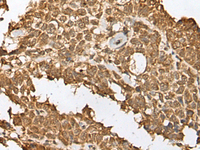 Immunohistochemistry of paraffin-embedded Human ovarian cancer tissue using RBL2 Polyclonal Antibody at dilution of 1:45 (×200)