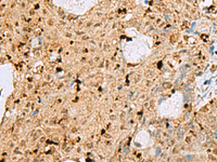 Immunohistochemistry of paraffin-embedded Human ovarian cancer tissue using MAF Polyclonal Antibody at dilution of 1:25 (×200)