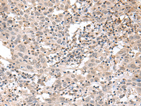 Immunohistochemistry of paraffin-embedded Human cervical cancer tissue using TDP2 Polyclonal Antibody at dilution of 1:75 (×200)