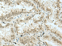 Immunohistochemistry of paraffin-embedded Human lung cancer tissue using HAS1 Polyclonal Antibody at dilution of 1:70 (×200)