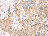 Immunohistochemistry of paraffin-embedded Human esophagus cancer tissue using YRDC Polyclonal Antibody at dilution of 1:30 (×200)