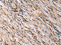 Immunohistochemistry of paraffin-embedded Human colorectal cancer tissue using ECM1 Polyclonal Antibody at dilution of 1:25 (×200)