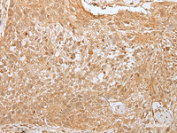 Immunohistochemistry of paraffin-embedded Human lung cancer tissue using MORF4L1 Polyclonal Antibody at dilution of 1:30 (×200)