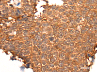 Immunohistochemistry of paraffin-embedded Human ovarian cancer tissue using HOXD8 Polyclonal Antibody at dilution of 1:40 (×200)