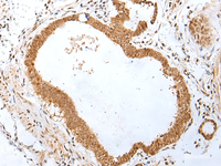 Immunohistochemistry of paraffin-embedded Human gastric cancer tissue using PEG3 Polyclonal Antibody at dilution of 1:45 (×200)