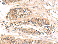 Immunohistochemistry of paraffin-embedded Human colorectal cancer tissue using ABCB4 Polyclonal Antibody at dilution of 1:70 (×200)