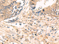 Immunohistochemistry of paraffin-embedded Human colorectal cancer tissue using ABHD2 Polyclonal Antibody at dilution of 1:40 (×200)