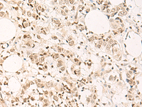 Immunohistochemistry of paraffin-embedded Human breast cancer tissue using DPPA4 Polyclonal Antibody at dilution of 1:55 (×200)