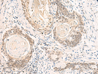 Immunohistochemistry of paraffin-embedded Human esophagus cancer tissue using DPPA4 Polyclonal Antibody at dilution of 1:55 (×200)