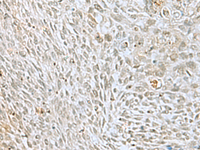 Immunohistochemistry of paraffin-embedded Human lung cancer tissue using HOXC9 Polyclonal Antibody at dilution of 1:40 (×200)