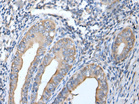 Immunohistochemistry of paraffin-embedded Human cervical cancer tissue using HSPB1 Polyclonal Antibody at dilution of 1:25 (×200)