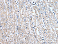 Immunohistochemistry of paraffin-embedded Human gastric cancer tissue using SPTA1 Polyclonal Antibody at dilution of 1:80 (×200)