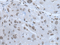 Immunohistochemistry of paraffin-embedded Human esophagus cancer tissue using HAND1 Polyclonal Antibody at dilution of 1:30 (×200)