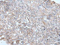 Immunohistochemistry of paraffin-embedded Human lung cancer tissue using ETFB Polyclonal Antibody at dilution of 1:40 (×200)