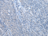 Immunohistochemistry of paraffin-embedded Human liver cancer tissue using ZBTB3 Polyclonal Antibody at dilution of 1:55 (×200)