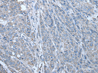 Immunohistochemistry of paraffin-embedded Human liver cancer tissue using ZC3HAV1 Polyclonal Antibody at dilution of 1:70 (×200)