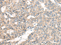 Immunohistochemistry of paraffin-embedded Human liver cancer tissue using LRP1B Polyclonal Antibody at dilution of 1:50 (×200)