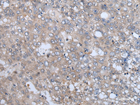 Immunohistochemistry of paraffin-embedded Human liver cancer tissue using VAMP4 Polyclonal Antibody at dilution of 1:50 (×200)