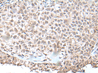 Immunohistochemistry of paraffin-embedded Human ovarian cancer tissue using UBN1 Polyclonal Antibody at dilution of 1:130 (×200)