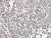 Immunohistochemistry of paraffin-embedded Human tonsil tissue using UBN1 Polyclonal Antibody at dilution of 1:130 (×200)