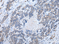 Immunohistochemistry of paraffin-embedded Human thyroid cancer tissue using ATM Polyclonal Antibody at dilution of 1:65 (×200)