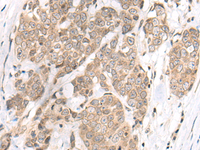 Immunohistochemistry of paraffin-embedded Human thyroid cancer tissue using M1AP Polyclonal Antibody at dilution of 1:80 (×200)