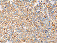 Immunohistochemistry of paraffin-embedded Human liver cancer tissue using CAPN9 Polyclonal Antibody at dilution of 1:45 (×200)