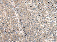 Immunohistochemistry of paraffin-embedded Human liver cancer tissue using CC2D1A Polyclonal Antibody at dilution of 1:35 (×200)