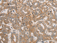 Immunohistochemistry of paraffin-embedded Human liver cancer tissue using CEND1 Polyclonal Antibody at dilution of 1:50 (×200)