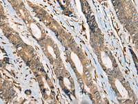 Immunohistochemistry of paraffin-embedded Human gastric cancer tissue using ODF2 Polyclonal Antibody at dilution of 1:110 (×200)