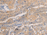 Immunohistochemistry of paraffin-embedded Human thyroid cancer tissue using AGAP3 Polyclonal Antibody at dilution of 1:25 (×200)