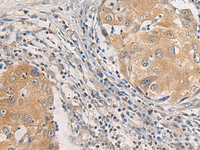 Immunohistochemistry of paraffin-embedded Human breast cancer tissue using AGAP3 Polyclonal Antibody at dilution of 1:25 (×200)