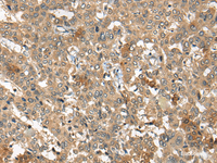 Immunohistochemistry of paraffin-embedded Human liver cancer tissue using ARCN1 Polyclonal Antibody at dilution of 1:50 (×200)